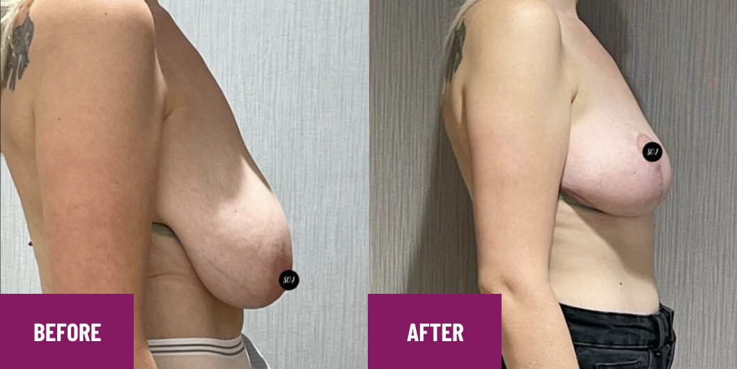 Service de réduction mammaire Avant et après