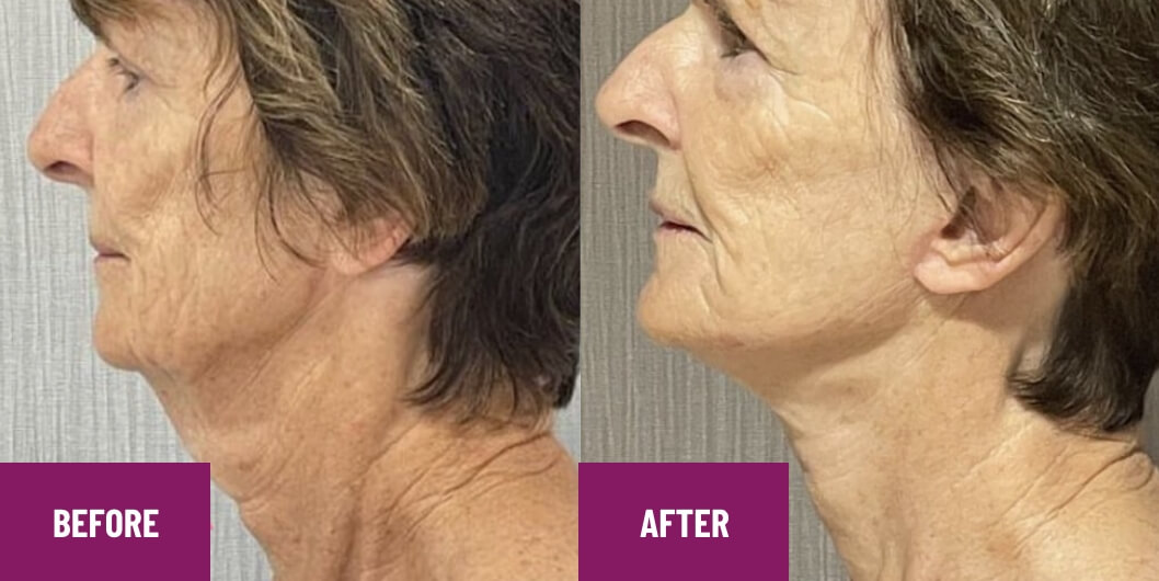 Servicio de lifting facial antes y después